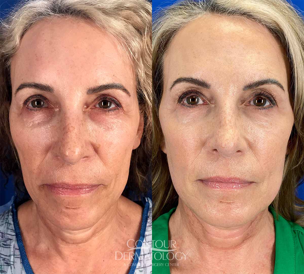 Mini Face Lift, antes y después, mujer de 58 años