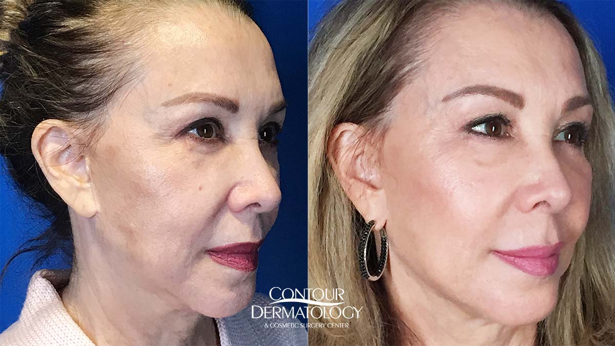 Lifting facial líquido con Juvéderm Voluma