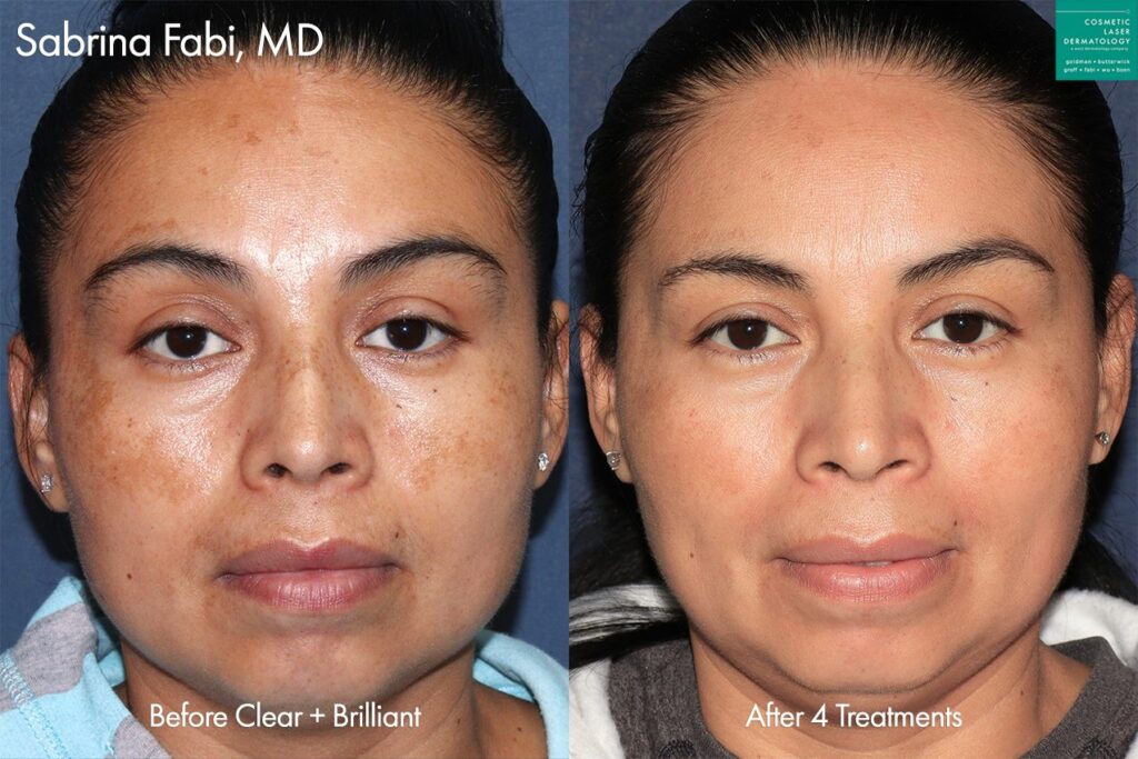 clderm Clear + Brilliant laser para tratar el melasma por la Dra. Fabi.  Después de 4 tratamientos, las manchas marrones son prácticamente indetectables san diego ca