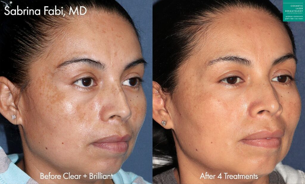 clderm Clear + Brilliant laser para tratar el melasma por la Dra. Fabi.  antes y después de san diego ca